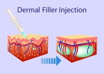 The Evolution of Aesthetics: Are Dermal Fillers Going Out of Fashion?