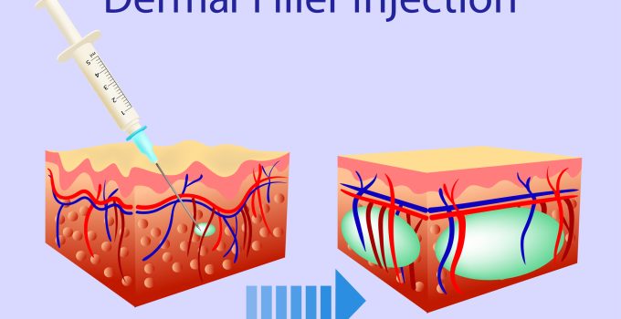 The Evolution of Aesthetics: Are Dermal Fillers Going Out of Fashion?
