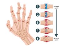 Exploring the Potential of Botox for Arthritis Pain Relief