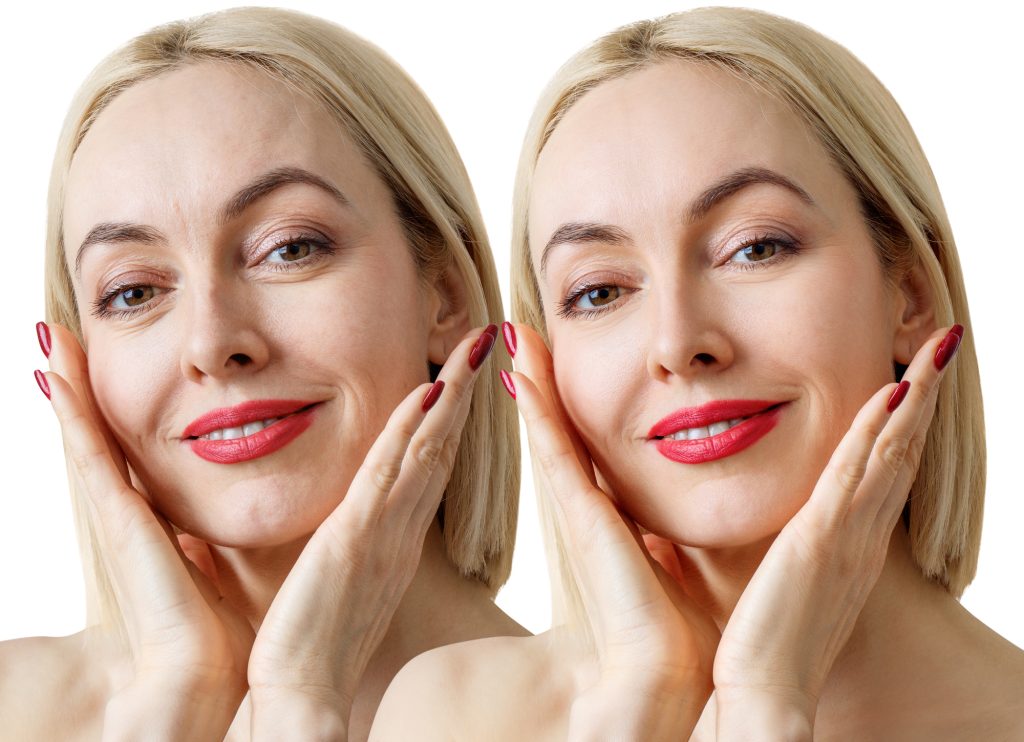 Botox has changed the landscape of cosmetic medicine by providing a risk-free way to reduce wrinkles and rejuvenate treatment.